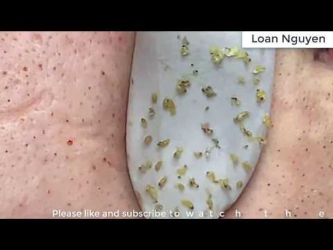 BEST BLACKHEADS OF THE WEEK | Loan Nguyen