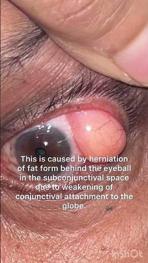 Orbital fat prolapse! Know about and get it treated early!