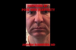 Profound RF  male patient for nasolabial  and marionette folds, jowls and jawline