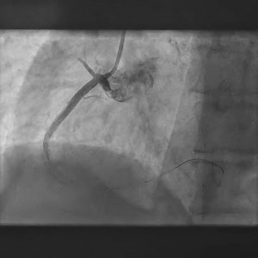 Philips Azurion Diagnostic suite déplacement de stent dans artère coronaire droite