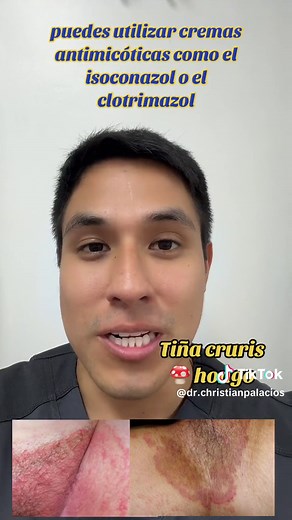 Mejor Crema para Hongos en la Piel - Dermatólogo Recomienda