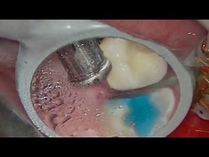 Maxillary Second Molar Crown Preparation under magnification with indirect vision