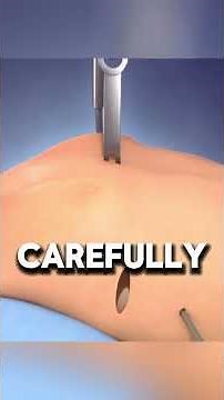 Pectus Excavatum Surgery