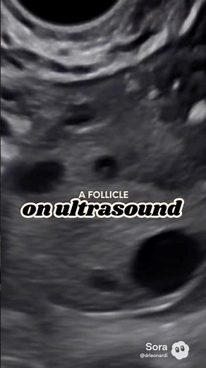 What a follicle looks like on transvaginal ultrasound