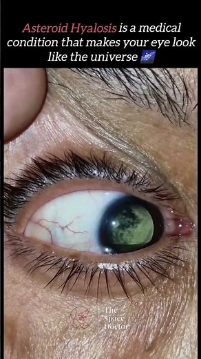Understanding Asteroid Hyalosis: Causes, Symptoms, and Treatments. #facts #symptoms
