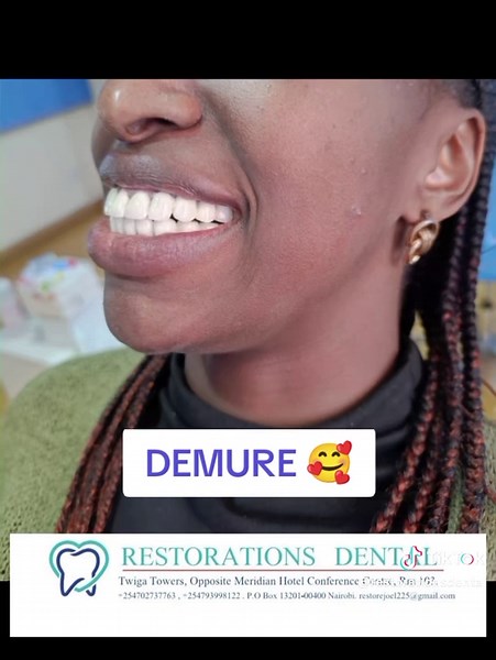 PORCELAIN CROWNS Beautiful just beautiful ❤️❤️#tiktoktips #dental #dentaltiktok #dentistry #dentist