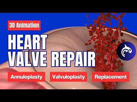 Understand Heart Valve Repair & Replacement: Annuloplasty, Valvuloplasty, and Valve Replacement