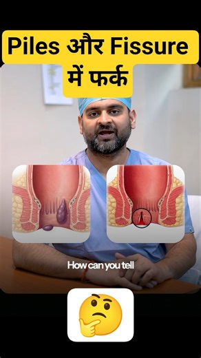 Piles vs Fissure - Dono alag kaise hain? | पाइल्स और फिशर में फर्क #piles #fissure