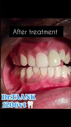 Crowning a Tooth After Fracture (Dental Restoration)