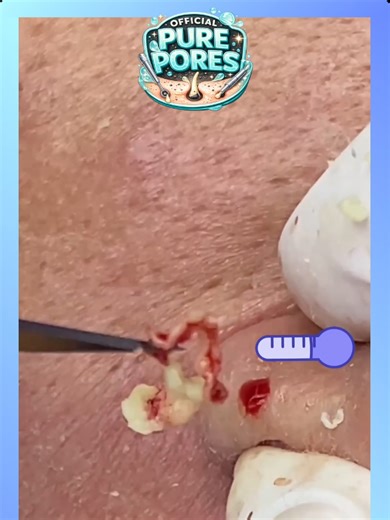 #14 - Shorts2 - Official Pure Pores Skin Care React to Soothing facial treatments ASMR @officialpurepores #blackheadremoval #pimplepopping #acneextraction Voice reaction and animations to Extreme blackhead removal, deep pore cleansing, intense acne extraction and satisfying skincare close-ups captured in HD and 4K macro detail. This video features real pimple popping, whitehead extraction, nose pore cleaning and deep skin cleansing designed to be relaxing and oddly satisfying. Watch clogged pore