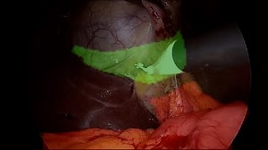 Toronto doctor develops AI prototype to guide surgeons during gallbladder surgery