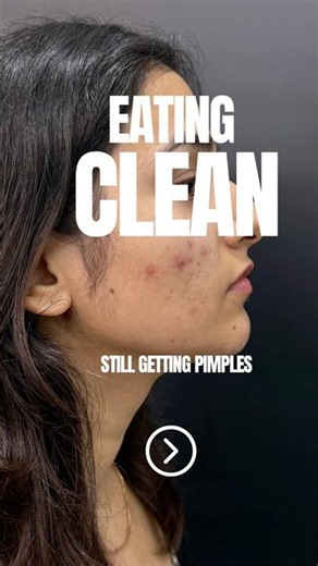 Eating good is still not cleaning ur Pimples. Watch this