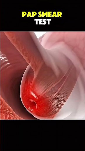 Ever wondered how a Pap smear test helps detect cervical changes befo... #Shorts