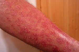 Psoriasis y sus causas emocionales · Laura Casart · Terapeuta Transpersonal