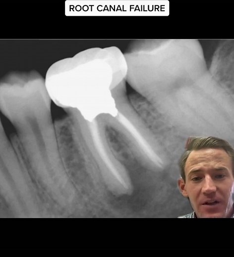 Signs Your Root Canal May Have Failed