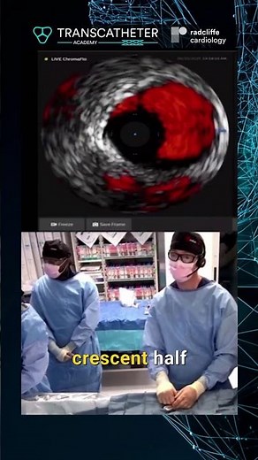 Dr Widmer's Cath Lab Guide to Coronary Reactivity Testing in Non‑Obstructive CAD - Session 5