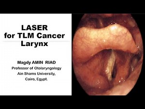 LASER for Cancer Larynx
