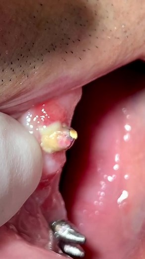 Tooth Abscess: Causes, Symptoms, and Treatment
