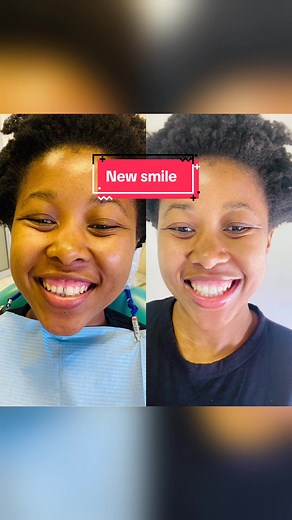 Transforming Your Smile: Gold Tooth Removal for a New Look