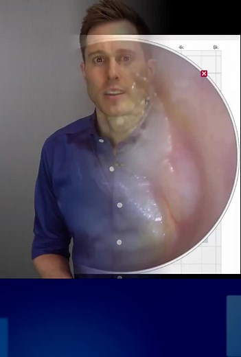 Leave something behind? Check out what Dr. Cliff finds in random ear canals! #gross #thinkyouleftthis #earhealth #drstories