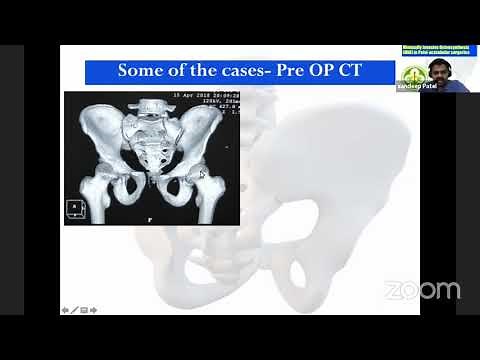 Minimally Invasive Surgery for Pelvis and Acetabulum