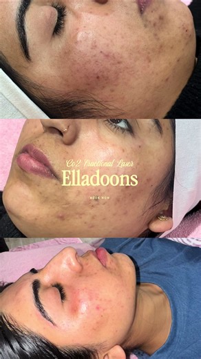 Discover CO2 Laser Skin Resurfacing Techniques