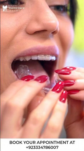 The Secret Behind Aligners | How Do Teeth Aligners Actually Work? | Tooth Crew Clinic.