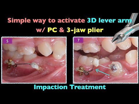 Impacted teeth treatment：simple way to activate 3D lever arm｜【Chris Chang Ortho】CC684