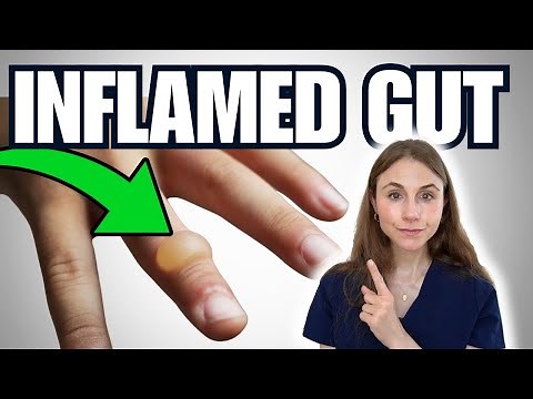 Signs Of Gut Inflammation NOT TO MISS | Skin Problems