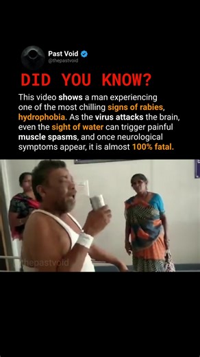 This video shows one of the most well-known neurological symptoms of rabies, called hydrophobia. As the rabies virus spreads to the brain, it disrupts the nervous system and causes severe spasms in the muscles responsible for swallowing. Even the sight, sound, or thought of water can trigger intense pain, choking sensations, and panic. The person may desperately want to drink — but their body physically prevents it. Rabies is preventable with early treatment. However, once neurological symptoms 