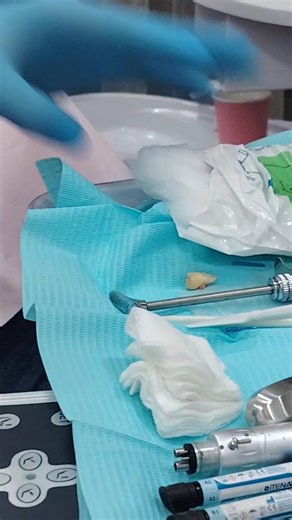 5-Second Wisdom Tooth Extraction! | Dr. Saleh Jany