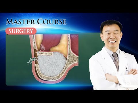 [Master Course - SURGERY] Management of Maxillary Sinus Infection
