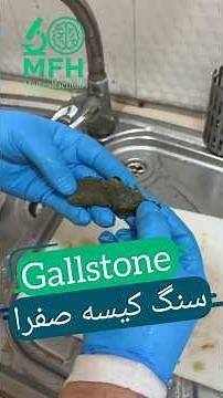 کیسه صفرا | Gallbladder