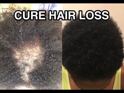 HOW TO CURE HAIR LOSS AND ALOPECIA FAST