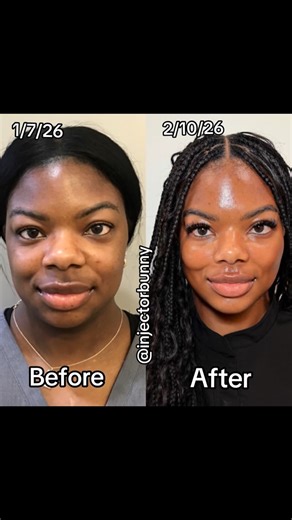 Erika Barry on Instagram: "Howling = jowling 😂😂😂 - Comment below- “Masseter” and I’ll send you this injection technique video 👇🏻👇🏻👇🏻👇🏻👇🏻 - I ask the patient to clench → palpate bulk Inject in upper (NOT THE LOWER) 1/3 of Masseter muscle. To avoid jowling Stay above mandibular border. - Just posted on Patreon. - My injection points are on Patreon...o But they are in the shape of a beard. 1. Upp