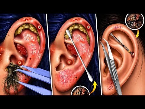 Extreme Ear Deep Cleaning & Nose Extraction ASMR 4K Gameplay