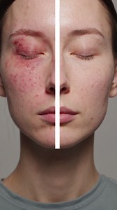 Before and After Acne Treatment | Premium Stock Video Footage