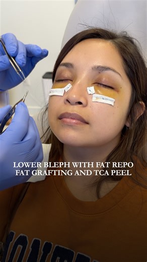 Christopher Zoumalan, MD FACS on Instagram: "Lower Bleph + Fat Repositioning + Fat Grafting + TCA Peel 6 days post-op. Still healing. Still early. Still powerful. This is what real recovery looks like. At 6 days, swelling, redness, and bruising are 100% normal. What you’re seeing is not the final result, it’s the transition phase. This patient had: • Lower blepharoplasty • Fat repositioning • Fat grafting for volume support • TCA peel to improve skin texture and tone Each step works on a differe