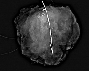 X-ray machine lets doctors check mid-surgery if they’ve removed all breast cancer cells