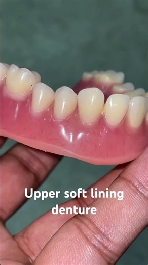 Upper soft lining denture 😬😬😬#apexdental #splittooth #dentistry #partialdenture #orthodontist