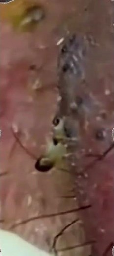 Deep Facial Extraction ASMR 😌🎧