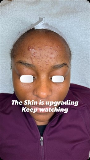 Adebimpe Akindele | hhbeautyspa | Acne & Skin Specialist on Instagram: "Another acne transformation ✨ Customized Biophora homecare + no-downtime Acne peels. Consistency always wins. Every week you postpone is another week your skin could be healing, correcting, and transforming. The clients who get the best results are the ones who start early and stay committed. Book your consultation, start your skin journey today. Schedule your appointment by clicking the link in my Bio. #acne #acnespecialist