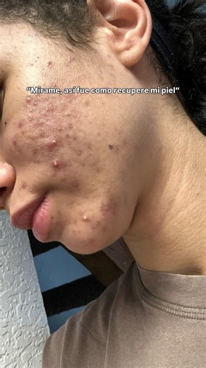 Luz Abreu | Nutrition & Health Coach on Instagram: "Tu dermatólogo nunca te dirá esto🥼 Desde los 17 años: brotes, dermatólogos, pastillas, suplementos, rutina de 6 pasos…. Nada funcionaba. Esto fue lo que realmente me devolvió la salud de mi piel 👇🏼 1️⃣ Ayuno Le dio descanso a mi intestino, redujo la inflamación, mejora sensibilidad a la insulina y activa la autofagia— proceso clave para regenerar las células de la piel. 2️⃣ Comer 2-3 veces x día— sin picar entre comidas y comer alto en prote