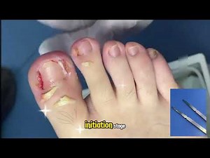 Swollen, Infected Ingrown Toenail with Proud Flesh Definitive Treatment Methods
