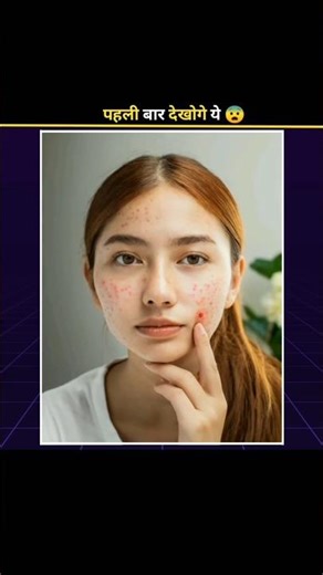 Why Do We Get Pimples 😨 #shorts #facts #pimple