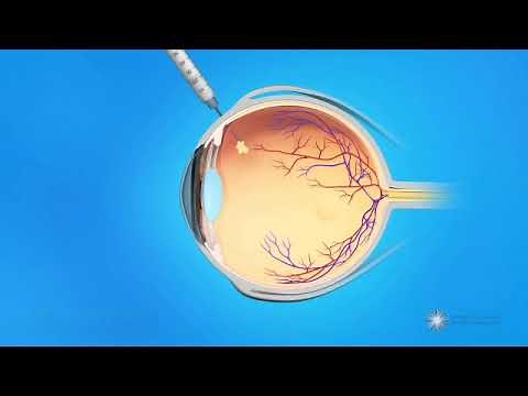 Injection intravitréenne - IVT - Traitement de la DMLA humide, du diabète et des occlusions