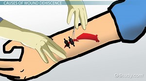 What Is Wound Dehiscence? - Definition & Treatment