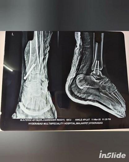 Medial malleolus screw fixation lag principle
