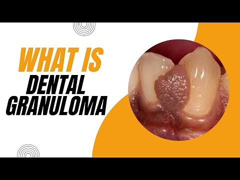 What is Dental Granuloma? Causes, Symptoms, and Treatment