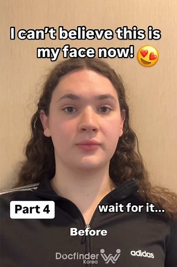 Facial Feminization Surgery Results in Korea
